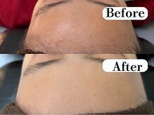 ビースキン 広島(BE:SKIN)/ミネラルピーリング/ニキビケア