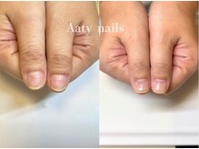 アーティネイルズ(Aaty Nails)/【深爪矯正】ハンド