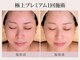 トリプルサンショップ 京都店の写真/【京都/四条】たるみ・むくみ・フェイスラインに。熟練ハンド×マシンで引き締まった小顔印象へ