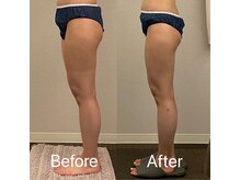 美容整体 レナトゥス 武庫之荘(Renatus)/針のいらない脂肪分解