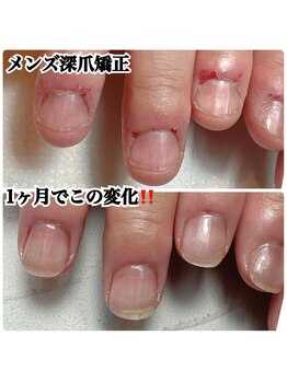 メンズ深爪矯正