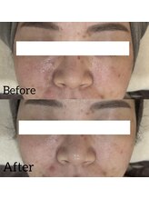 リラ(Lilas)/ニキビ肌へもアプローチ