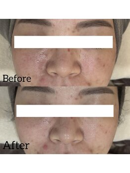 リラ(Lilas)/ニキビ肌へもアプローチ