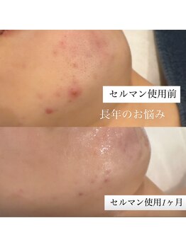 ロイヤル ビューティー サロン(Royal Beauty Saloon)/1ヶ月の変化　20代お客様