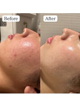 肌質改善専門【Salon da Mahina】毛穴ケア/ニキビケア/ハーブピーリング/ニキビ/ハーブピーリング/藤沢