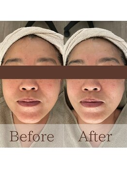 凪眠/小顔リンパフェイシャルの効果84