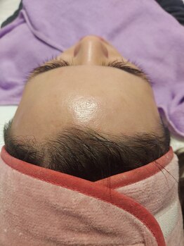 キアラ 麻布十番(Kiara)/顔脱毛　ブラジリアンワックス