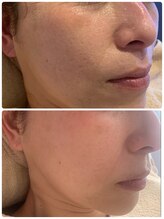 リジュベネ(rejuvena)/ハーブピーリング1回症例