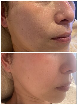 リジュベネ(rejuvena)/ハーブピーリング1回症例