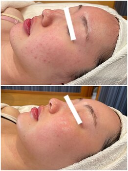 エクセレントビューティーサロン 艶(EN)/ダーマフェイシャル