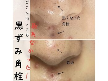 ジューンブライド(June Bride 61)/毛穴ケア