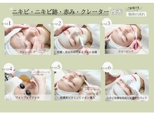 ビズビズ 梅田店(bisebise)/ニキビ/ニキビクーポン