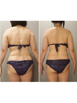 エイジングケア専門サロン サンク(thanq)/むくみ太り・上半身・凝り太り