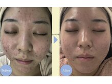 リノア 堀江(Linoa)/生コラーゲン美容液で超保湿◎