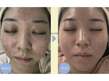 リノア 堀江(Linoa)/生コラーゲン美容液で超保湿◎