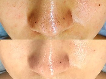 フルリール/【毛穴デトックス】