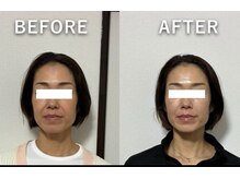 ビーフラット(B-flat)/初回施術前→4回目施術後