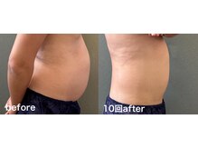 反り腰、腰痛に繋がるタプタプお腹でお困りの方、早めの改善を！