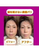 リラクゼーションサロン トゥジュール(Tujuhl)/エアバリフェイシャル★1回で！