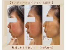 オキシー グレイス 黒崎店(OXY Grace)/INDIBA50代ビフォーアフター