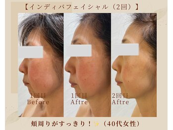 オキシー グレイス 黒崎店(OXY Grace)/INDIBA50代ビフォーアフター