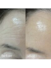 ユウユウ(YUYU)/純粋レチノールピール