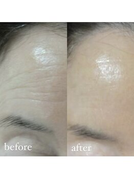 ユウユウ(YUYU)/純粋レチノールピール