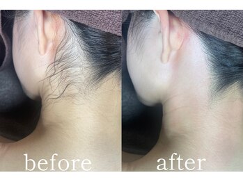 ムート(Mut.)/うなじワックス＋光脱毛。