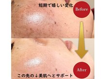 ボーテ デ ソレイユ(beaute de soleil)/集中★美肌改善でおなやみ解消へ