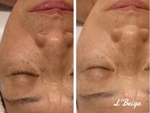 レ ベージュ(L’Beige)/リアボーテ肌質改善フェイシャル