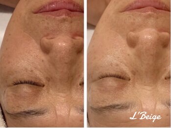 レ ベージュ(L’Beige)/リアボーテ肌質改善フェイシャル