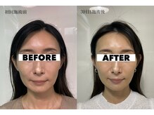 カドモリ 心斎橋(KADOMORI)/小顔矯正×美容鍼3回【美容鍼】