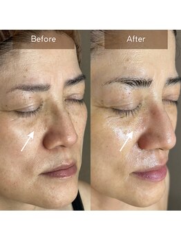 マヴィ(Mavie)/シミ・くすみ　Before→After