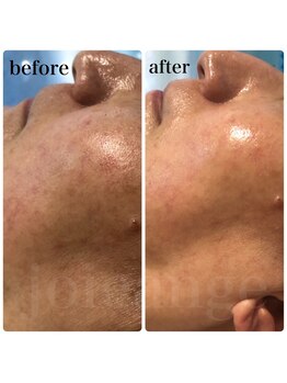 ジョアアンジェ 京橋店(joie ange)/レーザー後の赤み鎮静