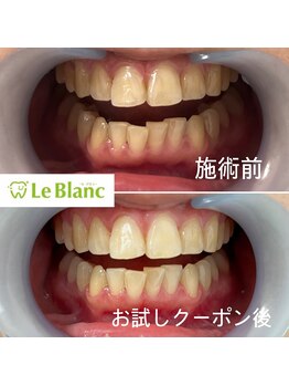 ルブラン 奈良店(Le Blanc)/続々と白い歯に(^^)