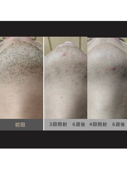 キムラケ 和光別邸(木村家 KIMURAKE)/メンズ脱毛ヒゲビフォーアフター
