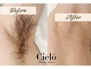 シエロ 赤坂店(Cielo)/『脇シュガーリング×美容脱毛』