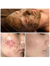 リ オアシス(Re:Oasis)/毛穴、くすみ、ニキビケア♪