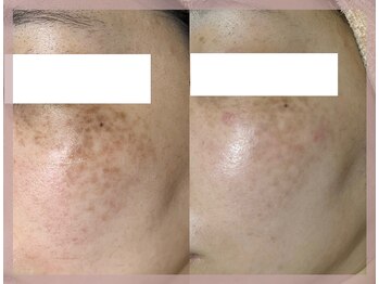 サロンクレア(SALON Claire)/メイクで隠れなかったシミも♪