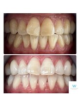 ホワイトニングショップ 奈良生駒店/歯の印象は笑顔の印象