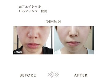 サロン エイトミー(salon 83)/光フェイシャル/before→after