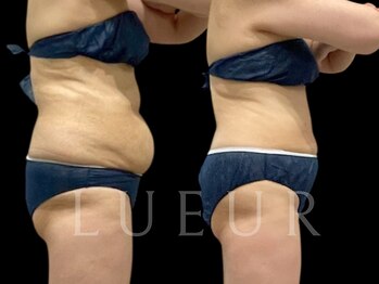 リュール北千住(LUEUR)/お腹施術事例