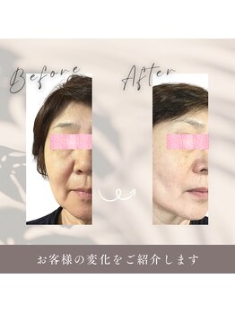 チチ(Chichi)の写真/ほうれい線・たるみ改善お任せ◎首、肩もほぐして年齢サインをケアして自信あふれる毎日を！