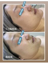 サロンドール(SalonDoll)/ハーブピーリング