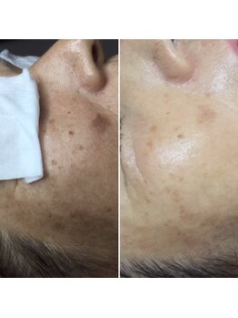 エクシア(ECXIA)/シミケア