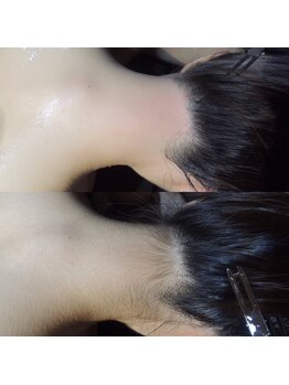 ソルーナ ブラジリアン ワックス 脱毛(SOLUNA)/処理しにくい部分も綺麗に♪