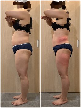 リボディ プラチナ(Rebody platinum)/脂肪冷却×全身ケア