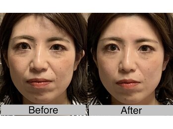 あおき鍼灸整骨院/小顔美容鍼　施術1回効果