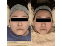 ヴェリティー(Verity)/ビフォーアフター