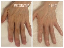 キレイテ 福岡天神店/50代/4回目【天神ハンドケア】